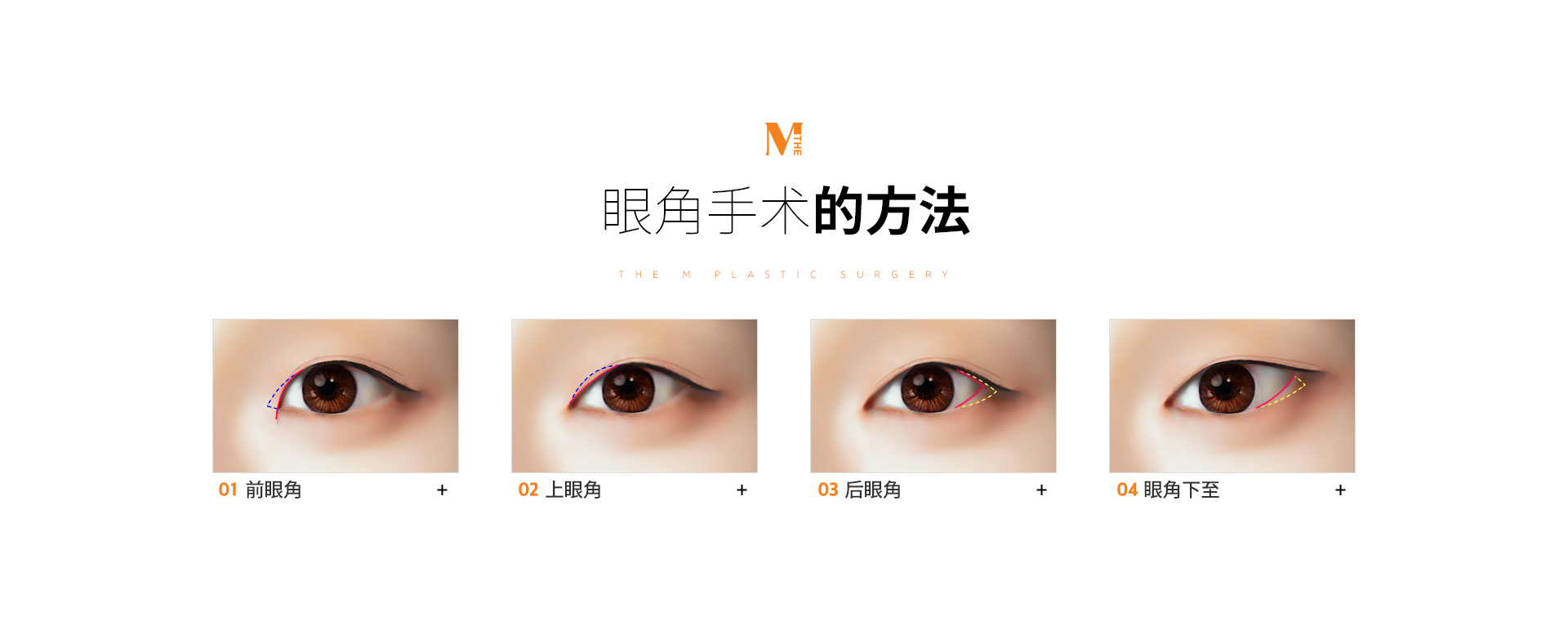 수술방법