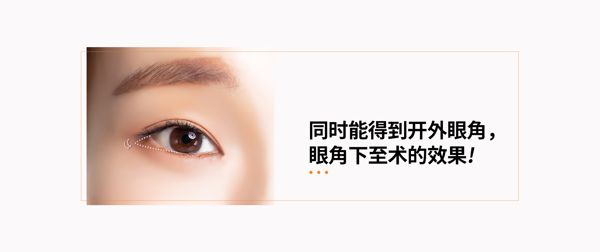 뒤트임밑트임 동시에