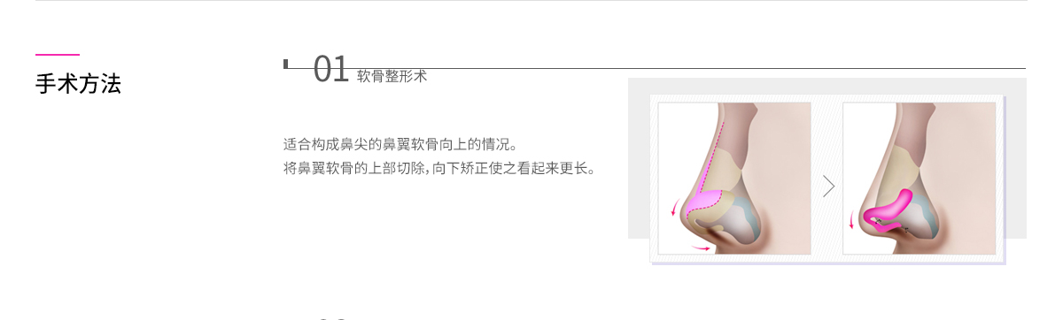 수술방법 - 하나 연골 성형술 : 코끝을 이루는 날개 연골이 위로 올라가 있는 경우에 해당합니다. 날개 연골의 위쪽을 잘라주고 다리를 아래쪽으로 고정하여 연골이 아래로 길어 보이게 교정합니다.
