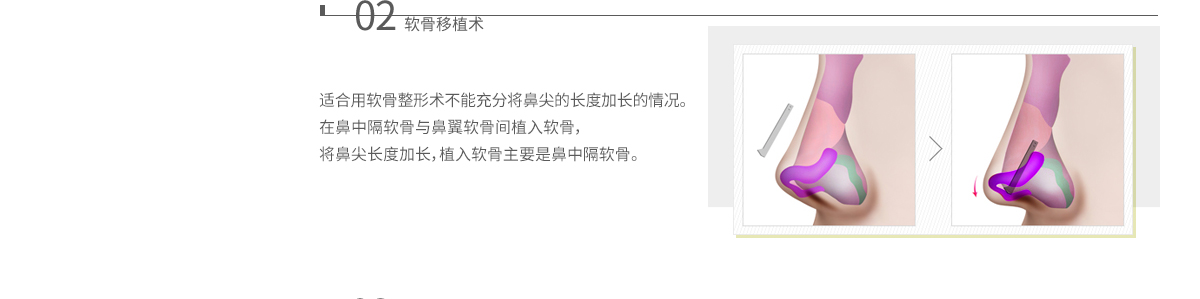 수술방법 - 둘 연골 이식술 : 연골성형술로 코끝의 길이를 충분히 늘려줄 수 없는 경우에 해당합니다. 비중격 연골과 날개 연골 사이에 추가적인 연골 이식을 통해 코끝의 길이를 늘려주는 연골 이식슬을 시행해야 하며 이식에 사용하는 연골은 주로 비중격 연골입니다.