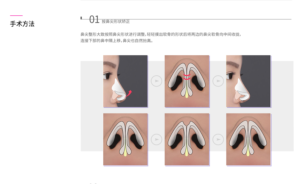 수술방법 - 하나 코끝에 맞게 교정 : 코끝성형은 코끝 모양에 맞게 교정하는데 연골의 모양을 날렵하게 다듬은 후 양쪽 코 끝 연골을 가운데로 모아 묶어줍니다. 아래쪽에 연결된 비중격이 위로 올라가 코가 자연스럽게 오똑해집니다.